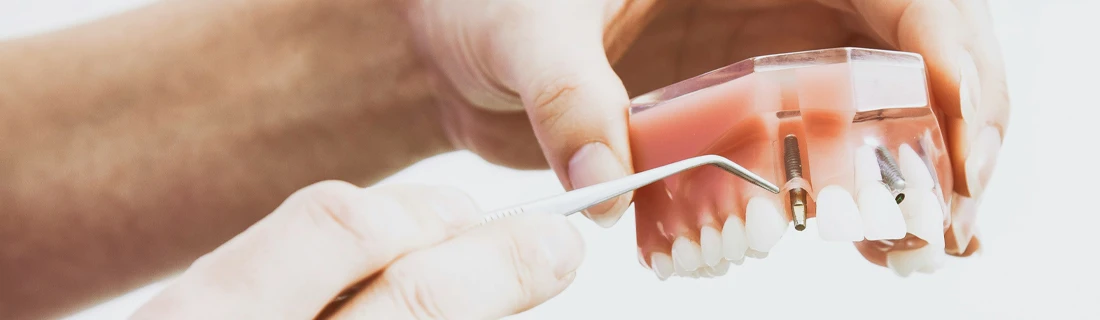 a dentist is pointing out a dental implant in a model of teeth