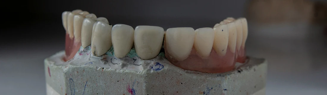 model of teeth showcasing various states of gum decay