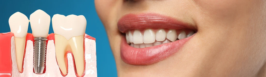 Dentist Sevierville TN Restorative Dentistry a close up of a woman's mouth smiling with a model of a dental implant